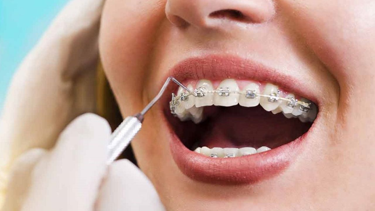 Ortodontik tedavide diş telleri mi, şeffaf plaklar mı?