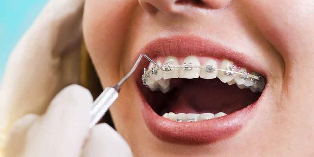 Ortodontik tedavide diş telleri mi, şeffaf plaklar mı?