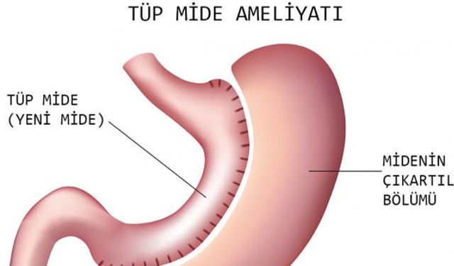 Tüp Mide (Sleeve Gastroctemy) Ameliyatı Nedir?