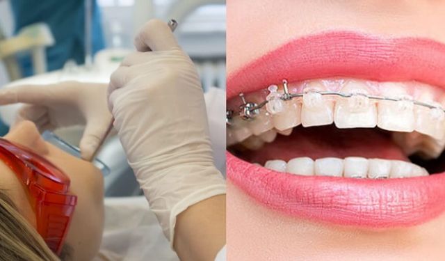 Ortodonti Tedavisi Yöntemleri Nelerdir?