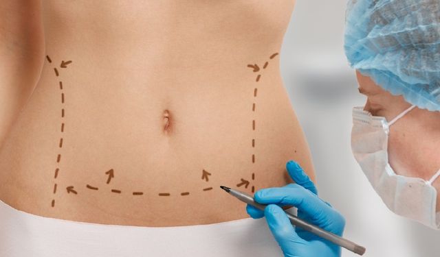 Liposuction Nedir? Nasıl Uygulanır?