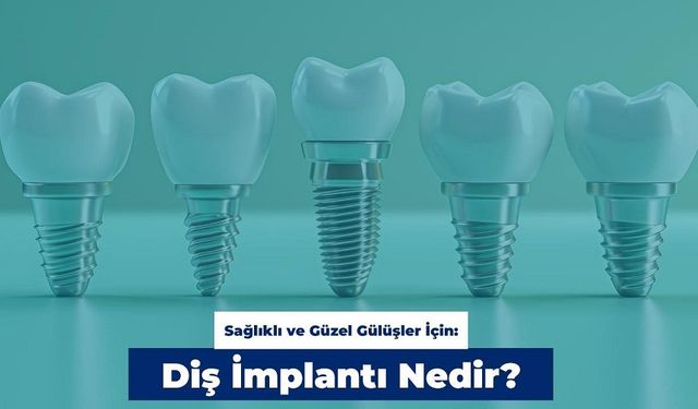 Sağlıklı ve Güzel Gülüşler İçin: Diş İmplantı Nedir?